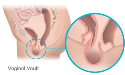 Vaginal vault prolapse occurs when the top part of the vaginal wall loses support and drops into the vagina.